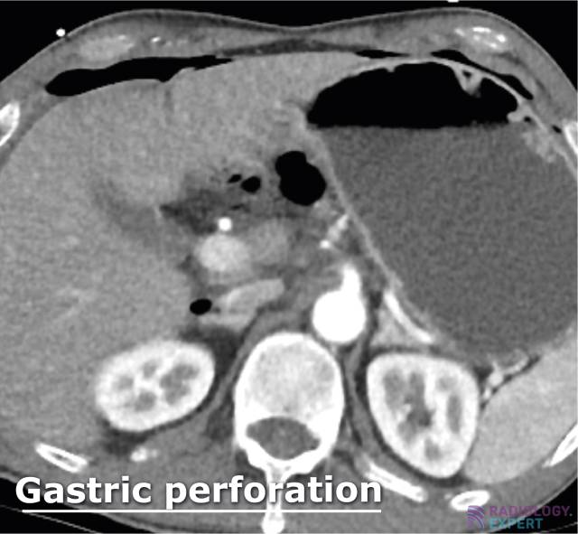 CT Abdomen General ct-abdomen-general